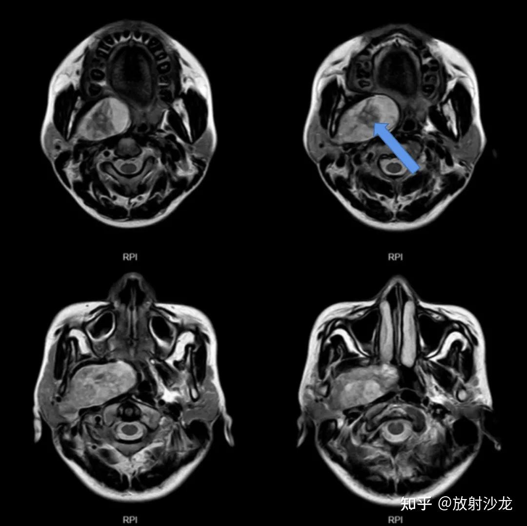 宫剑教授病例分享（四十一）“微创”手术在儿童颅咽管瘤与拉克氏囊肿中的应用 - 脑医汇 - 神外资讯 - 神介资讯