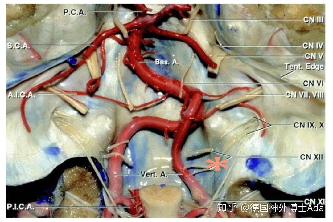 枕骨大孔疝瞳孔特点图片