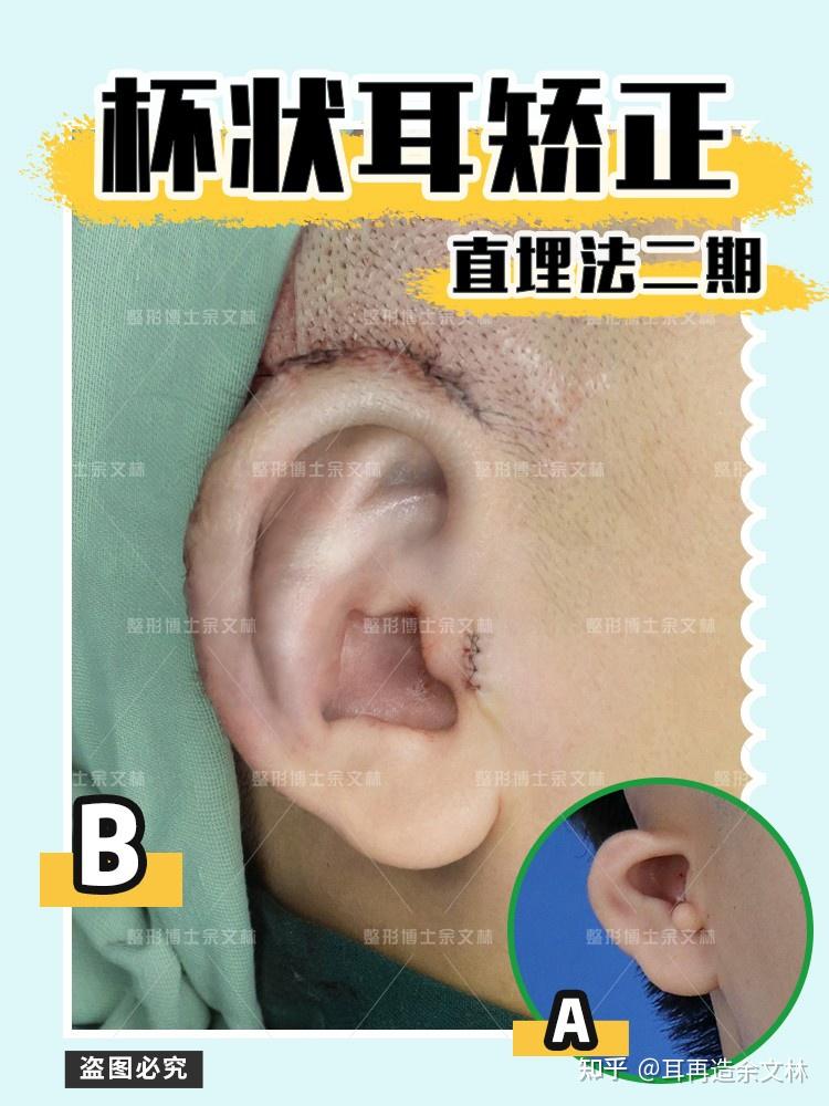 【案例分析】小伙子右侧重度杯状耳,采用直埋法耳再造治疗后让人惊喜