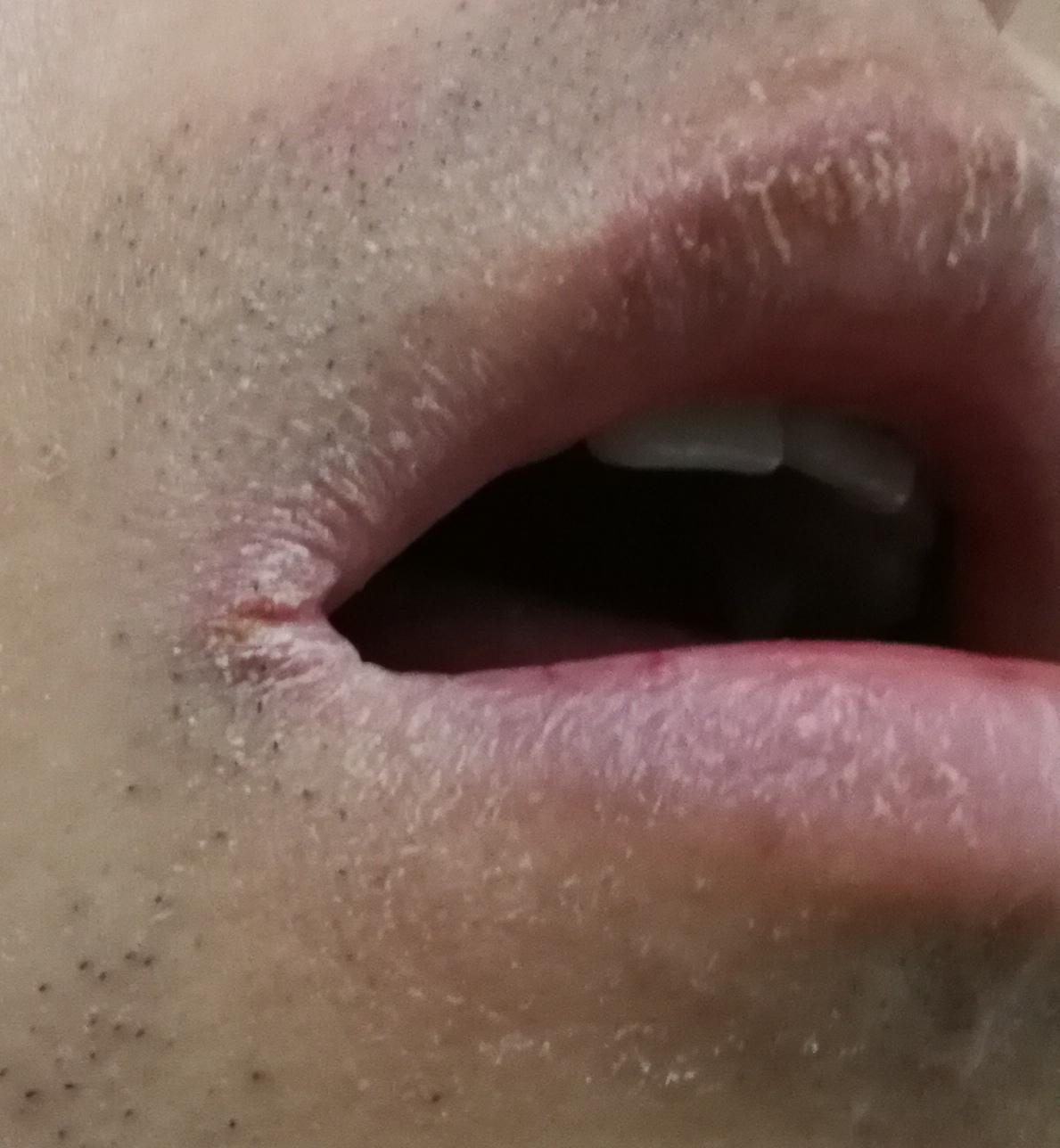 芒果过敏是一种怎样的感觉?