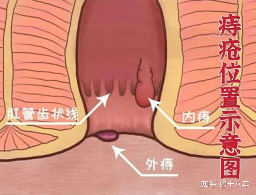 外痔的肉球图 症状图片