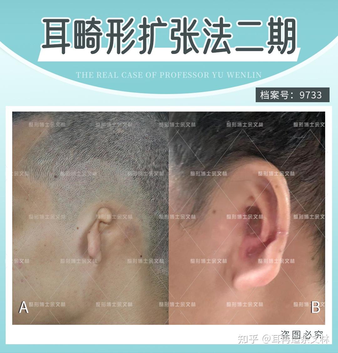 【小耳畸形】第一次耳再造手术后耳朵不太好看，还要再修吗？-余文林-爱问医生