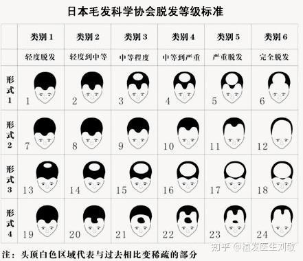 脱发的几种类型图片图片