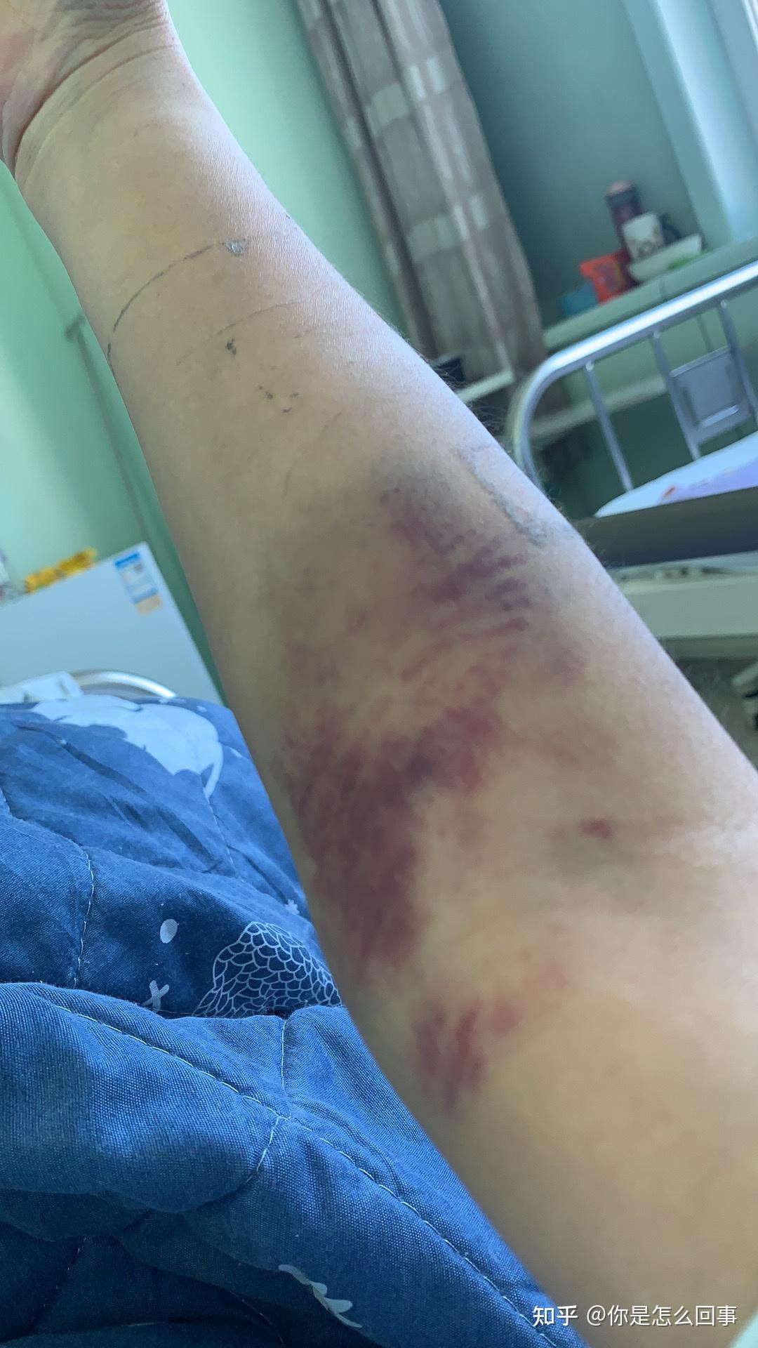 记录房缺开胸手术 - 知乎