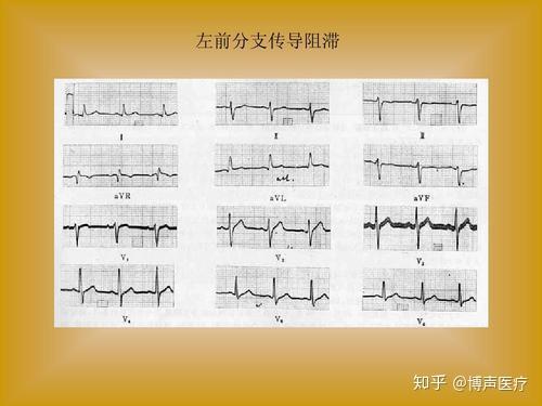 博声医疗 心电轴 心电轴右偏 知乎