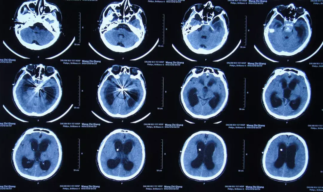 24歲男子巨大基底動脈瘤栓塞術後腦積水加重合並顱內感染經腦脊液科