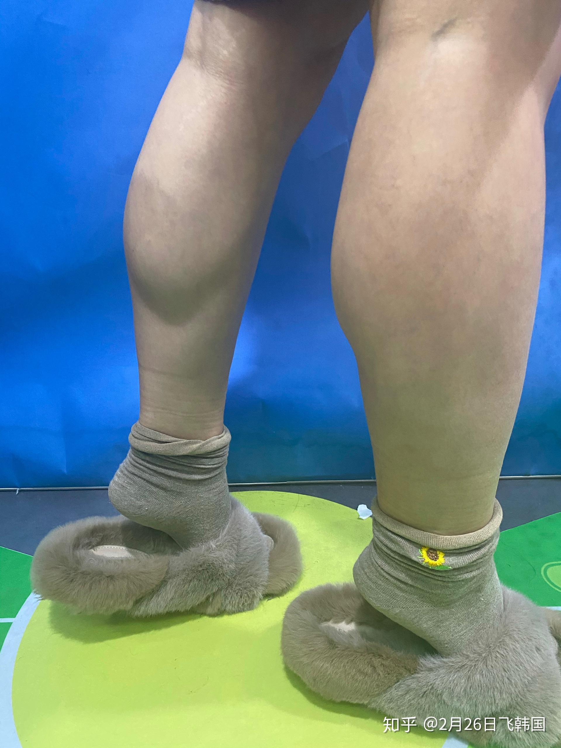 小腿围36厘米的姑娘打瘦腿针全过程