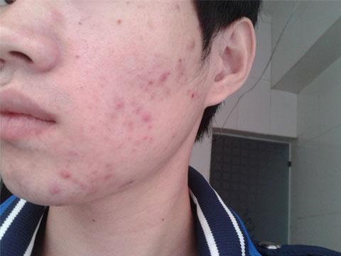 献给——被痘痘困扰住的男生