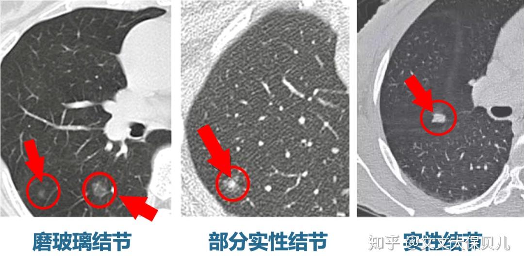 核保案例分享肺结节9mm磨玻璃肺结节6mm重疾险除外承保
