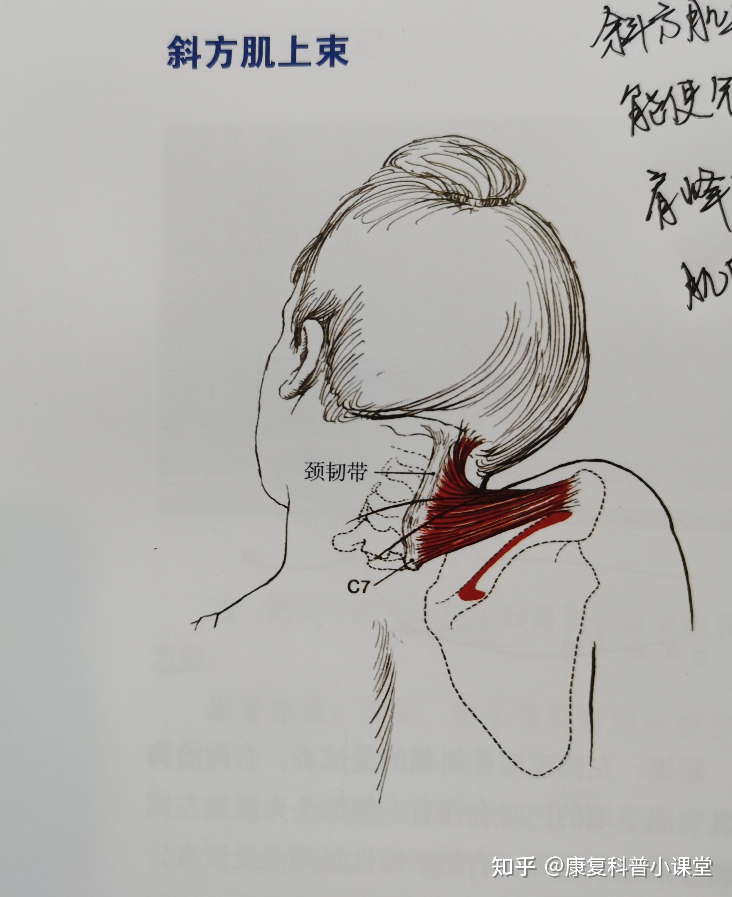 斜方肌上束挛缩型斜颈