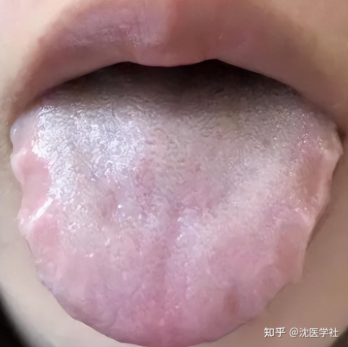 舌苔越厚，越不能补！这3种舌象别乱补，否则越补越上火 病也越多 - 知乎