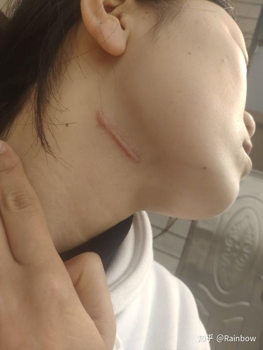 我的疤痕治疗之旅