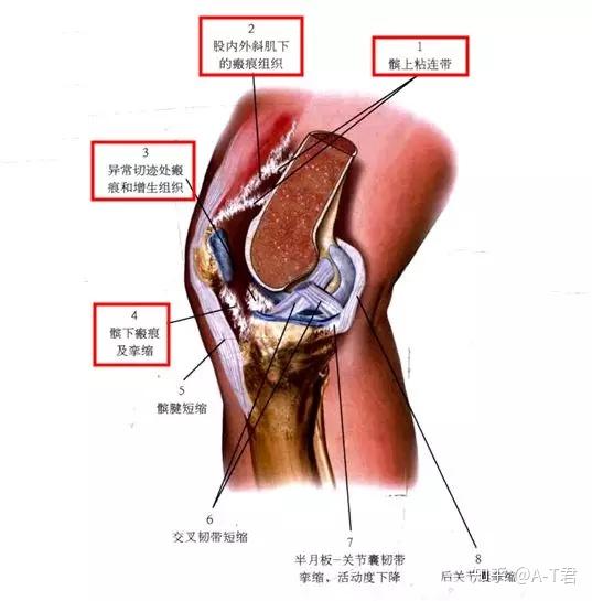 关节粘连,术后患者不可忽视的痛!