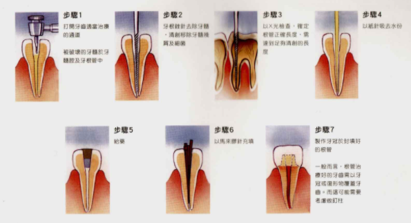 2分钟让你了解什么是根管治疗?根管到底贵不贵?根管流程是什么?这篇文章你不能错过! - 知乎