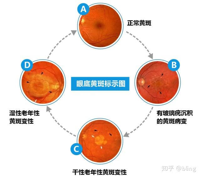 厦门眼科中心漳州眼底病专家:眼底出血≠眼睛充血,需及早治疗,否则