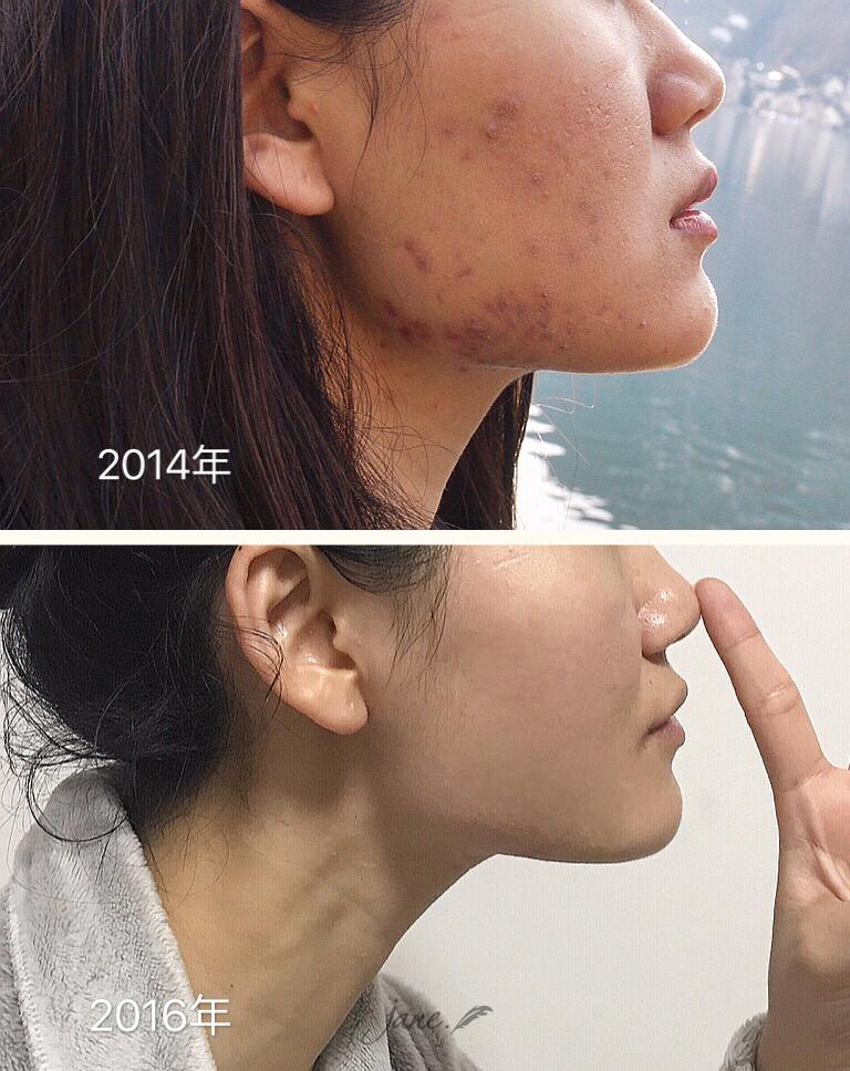 胜"痘"士的持久战(祛痘贴)