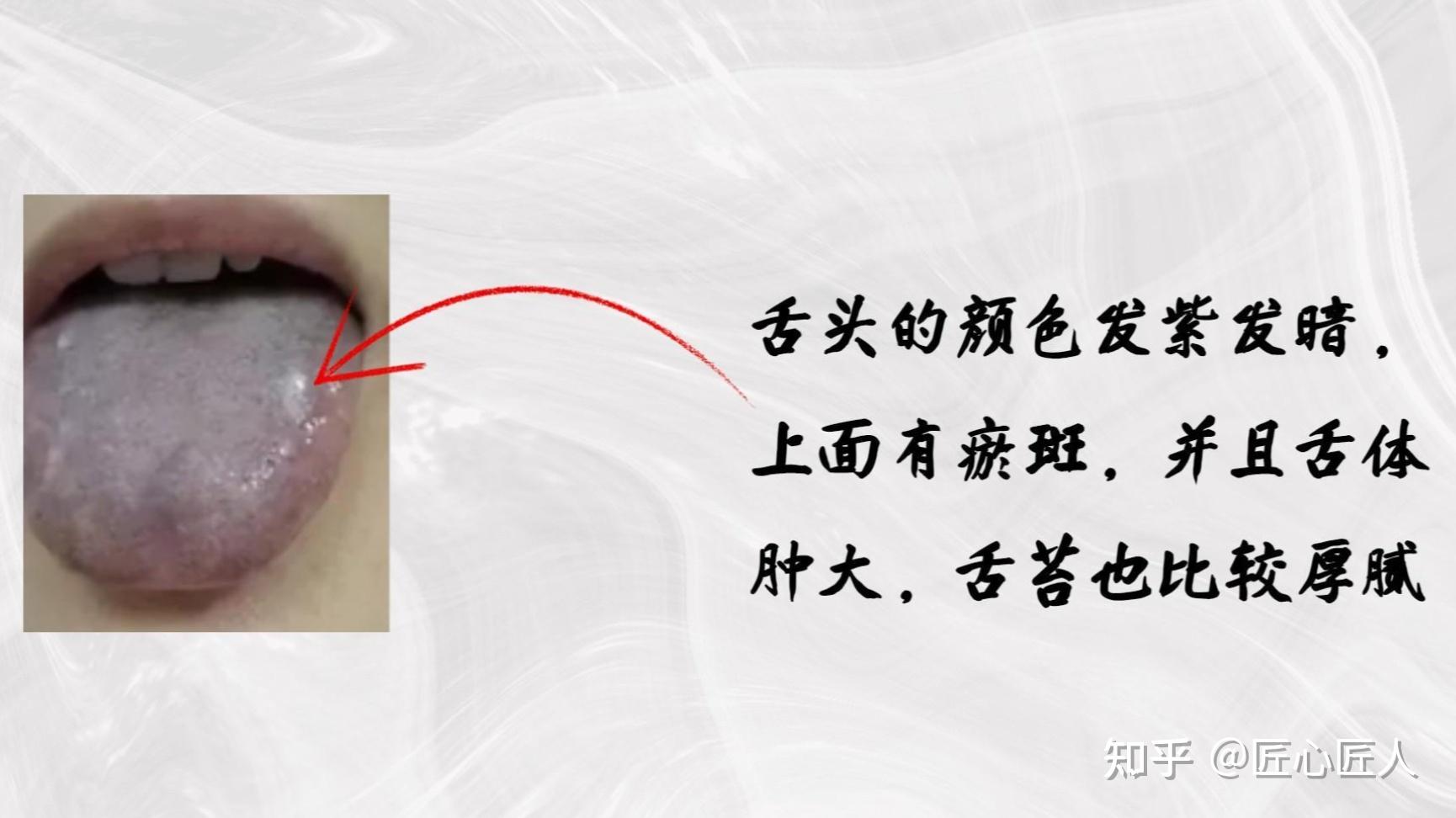 痰湿体质的人舌象都有什么特点？ - 知乎