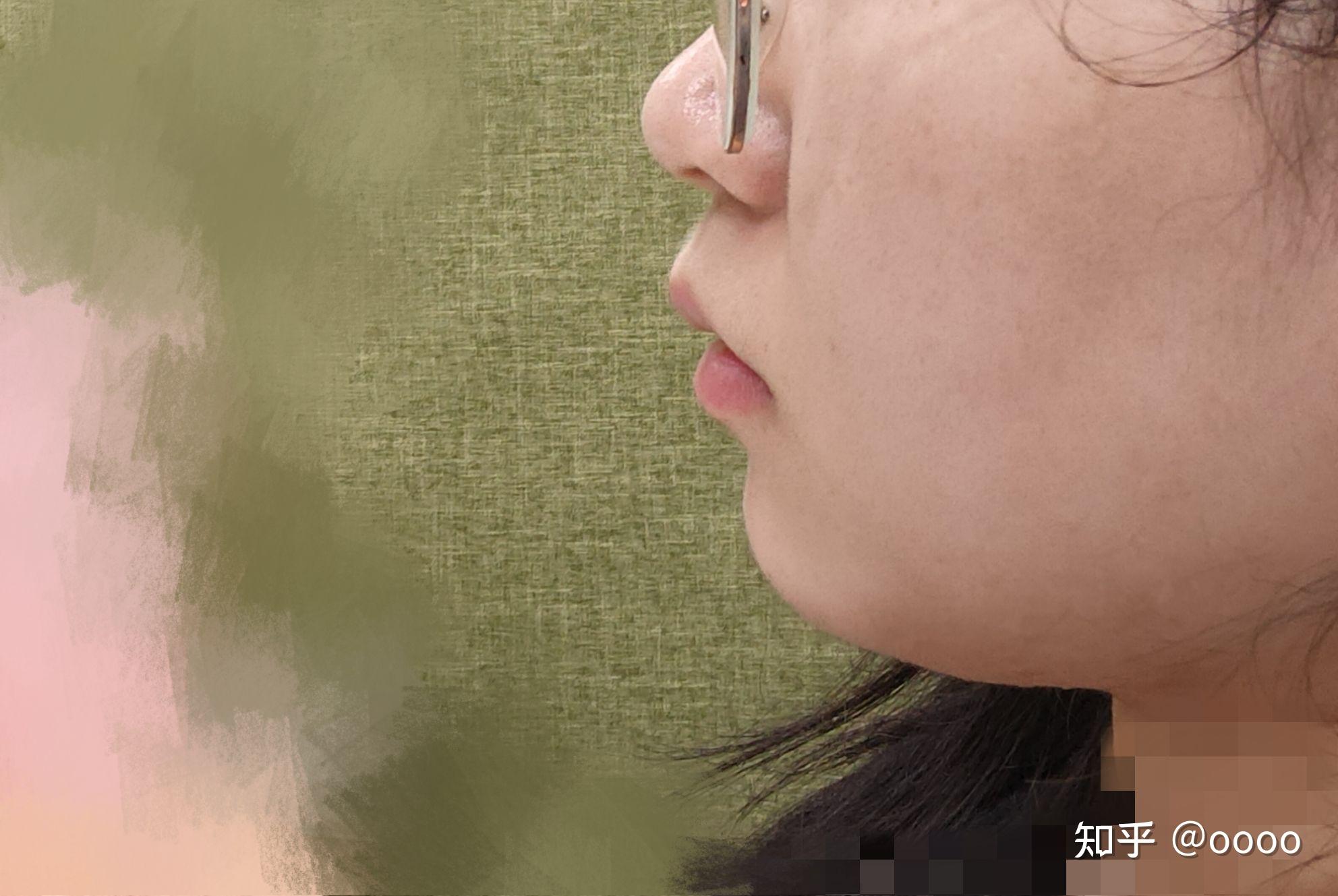 我到底是凸嘴还是人中肉厚? - 知乎