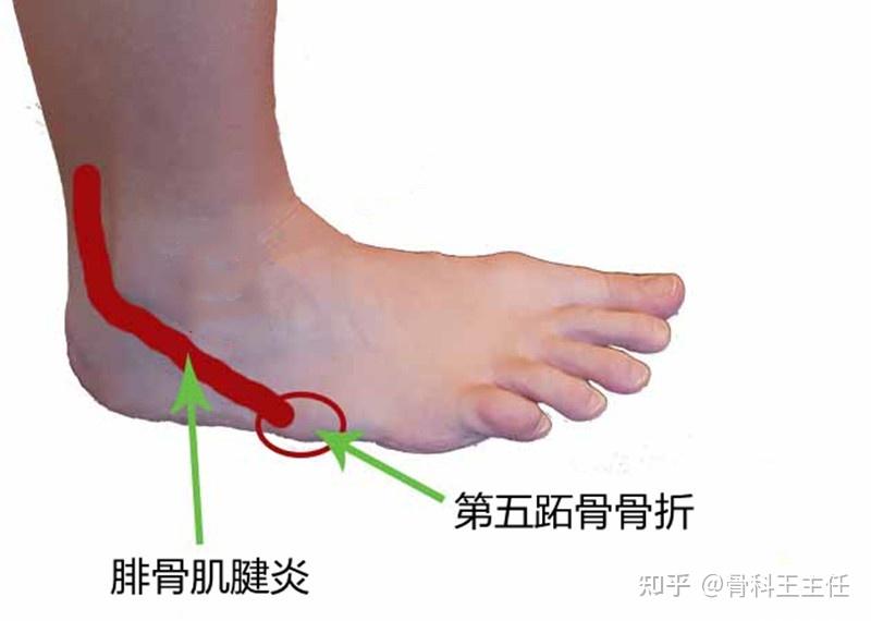 脚的外侧疼痛，位置不同轻重不同，不要大意了 - 知乎