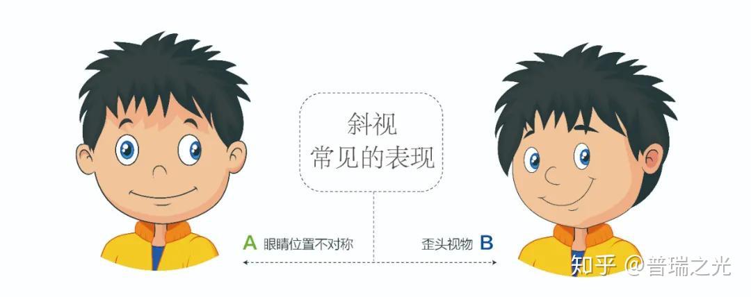 散光到底是怎麼回事能治好嗎一次給您說清楚