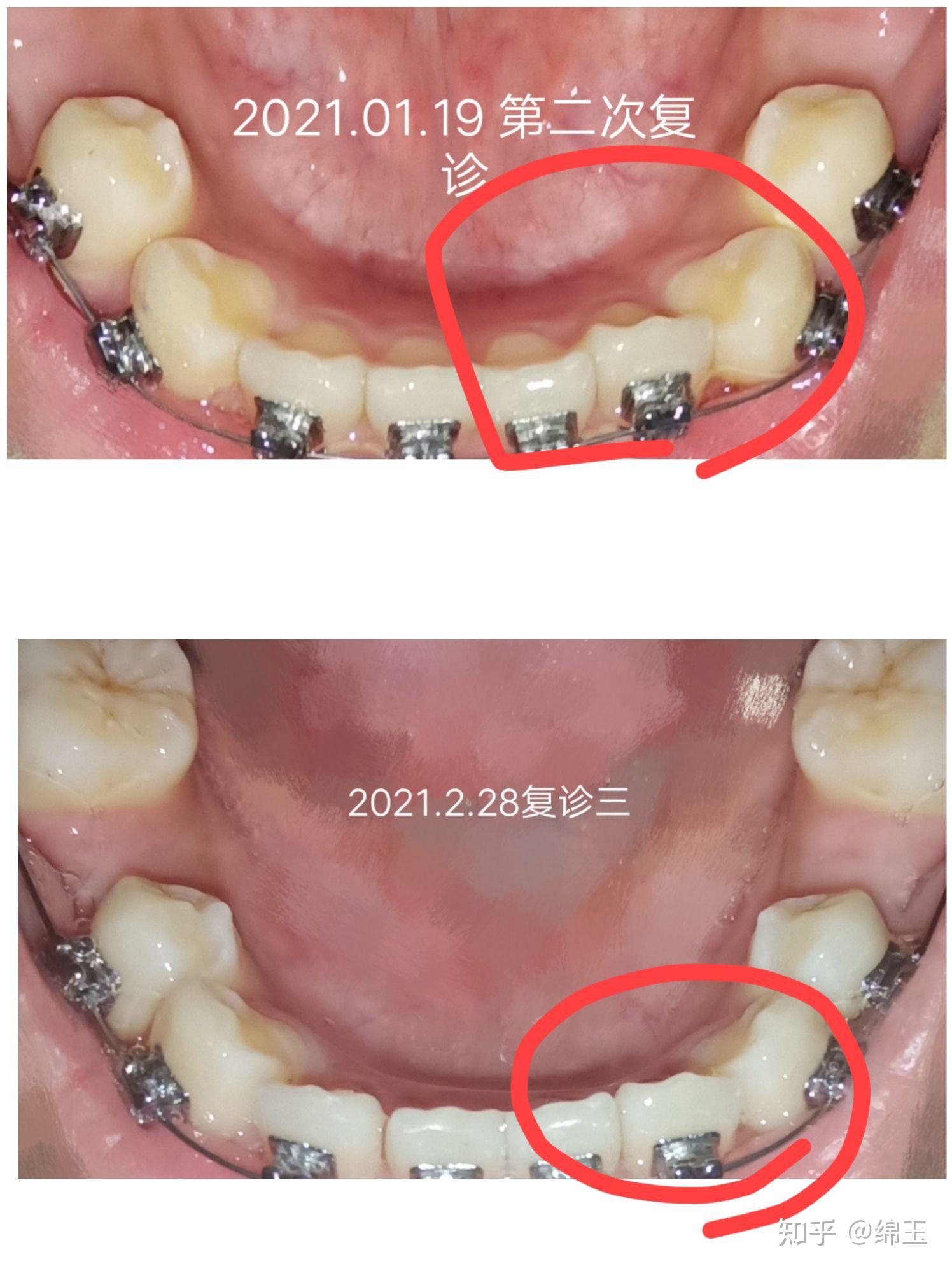 我也開始寫牙套記錄啦深覆合深覆蓋拔牙正畸金屬自鎖平導重慶19歲女生