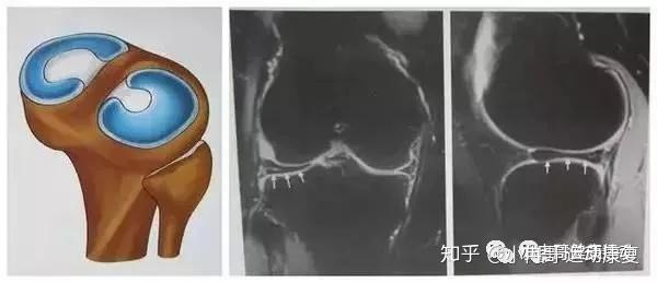 膝關節盤狀半月板指半月板先天發育所致解剖結構異常,邊緣肥厚,增寬