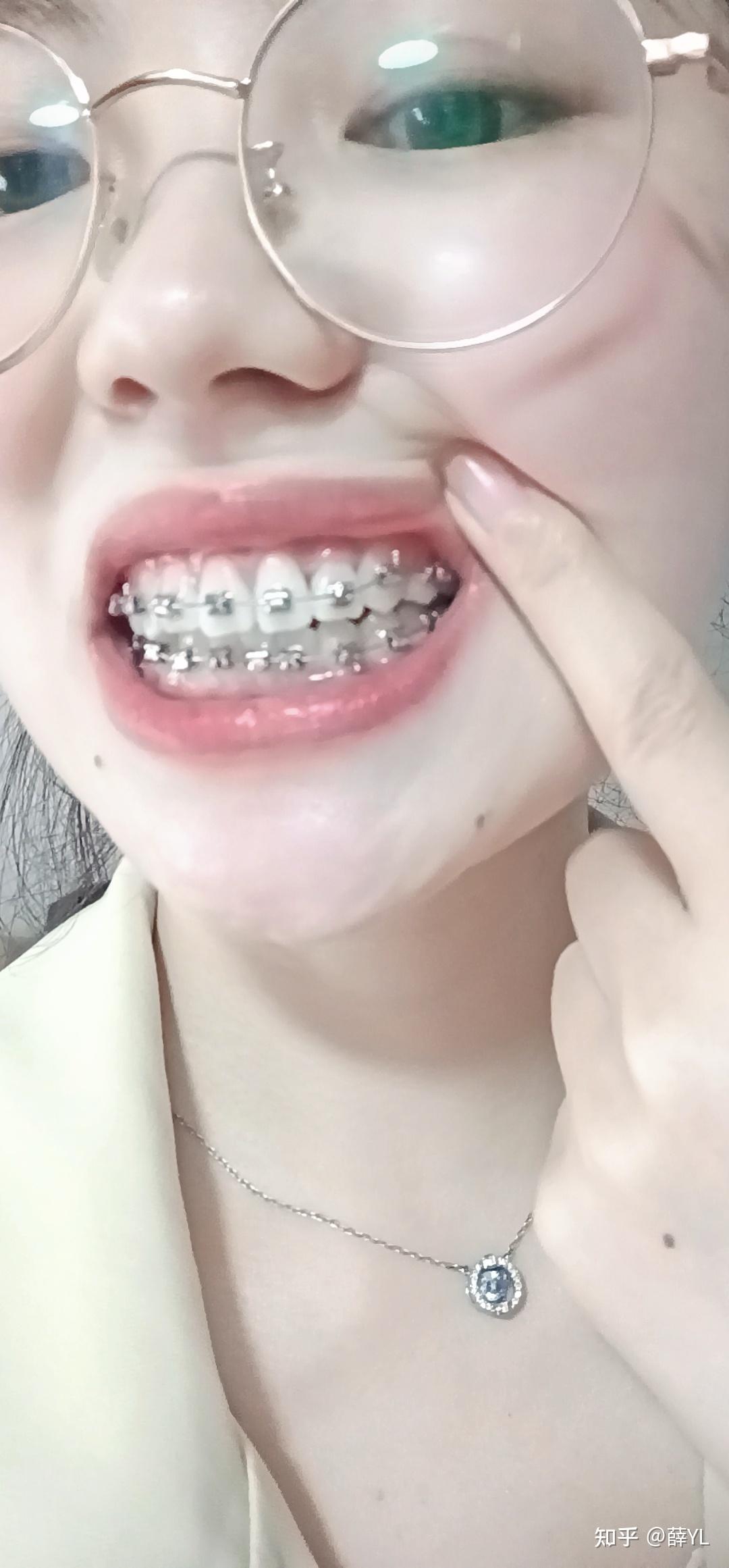 2021930虎牙矫正记录