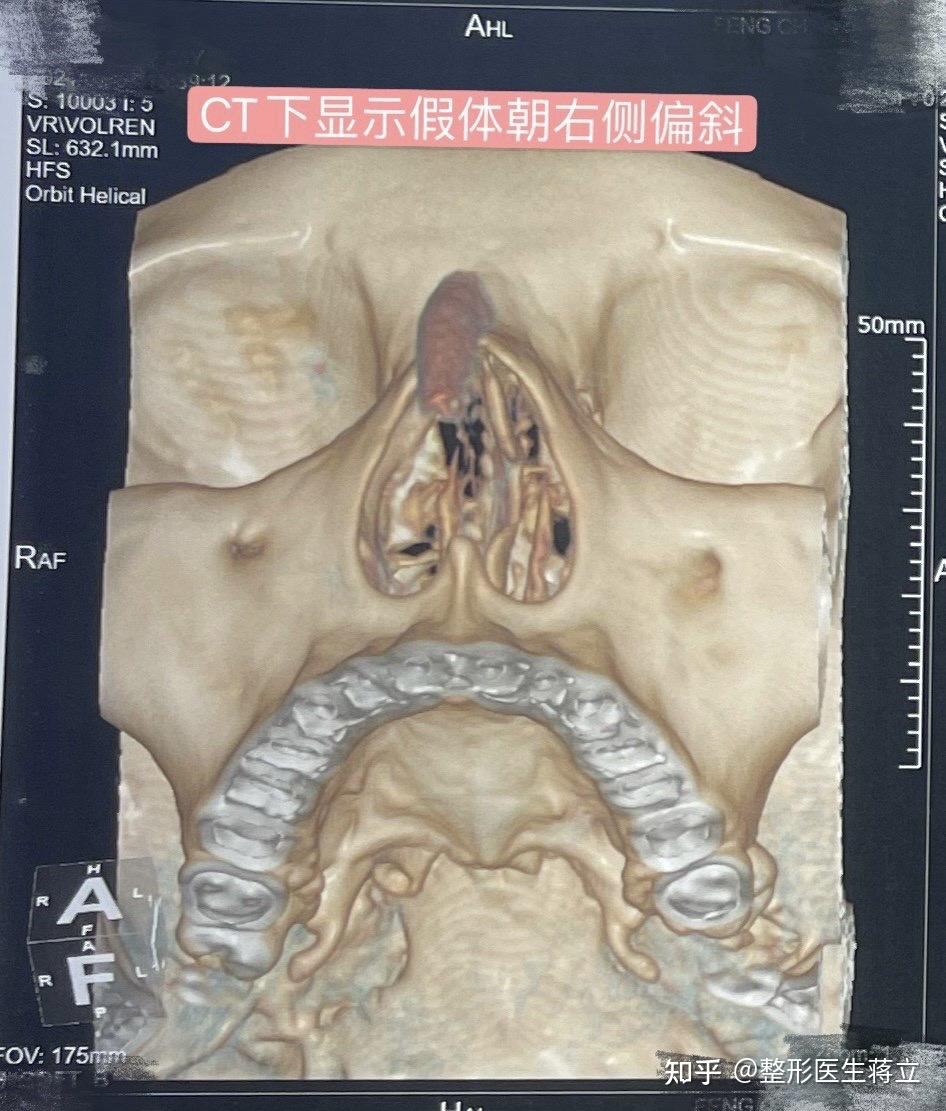 全肋鼻修复假体歪斜假体过高过顶鼻尖下小叶弧度缺失ct下显示假体明显