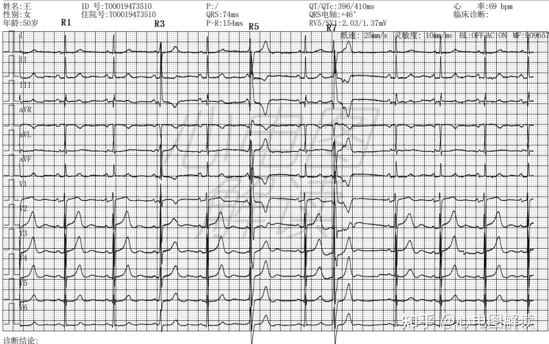 逸搏心电图图片