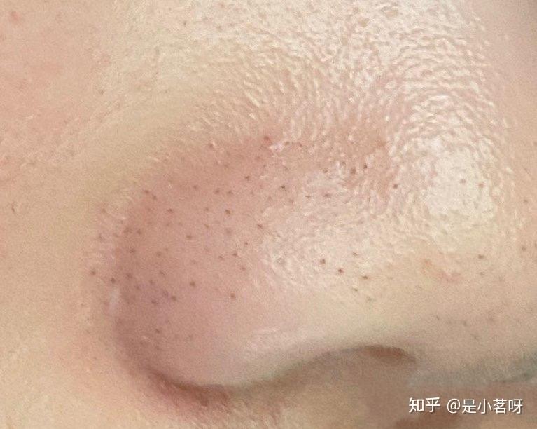 怎样可以祛黑头? - 知乎