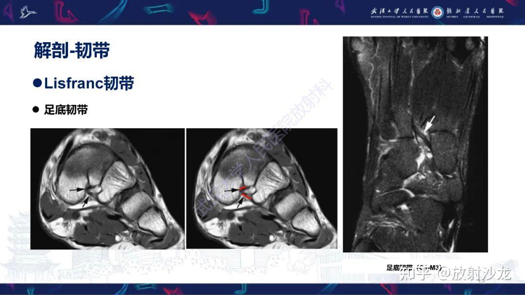 lisfranc关节图片