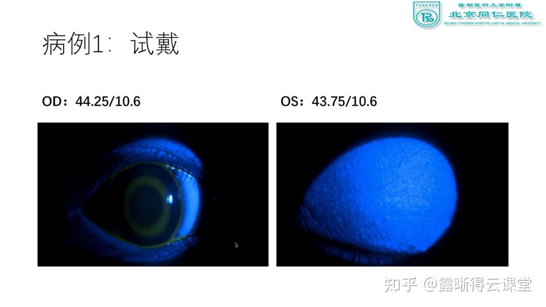 角膜地形图解读及露晰得塑形镜验配要点（文字版） - 知乎