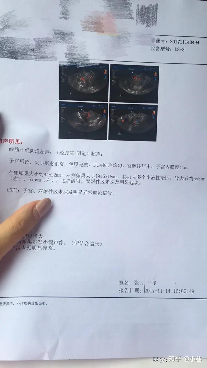我的多囊卵巢经历1
