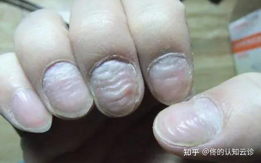 指甲表面出现的15种情况是反映身体缺乏哪些营养 - 知乎