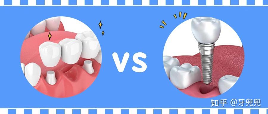 缺牙修复:固定桥vs种植牙,是你怎么选? - 知乎
