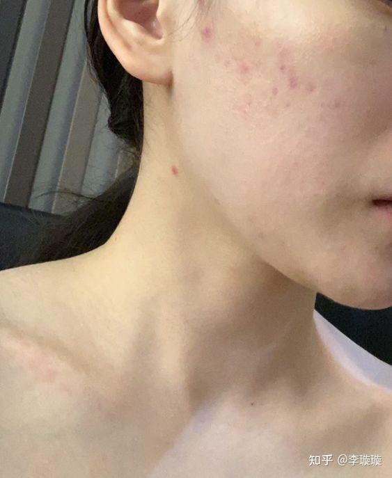 痘印是痘痘产生后的炎症色素沉着形成的.