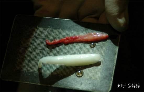 硅胶隆鼻和膨体隆鼻的差别膨体真的要比硅胶好吗