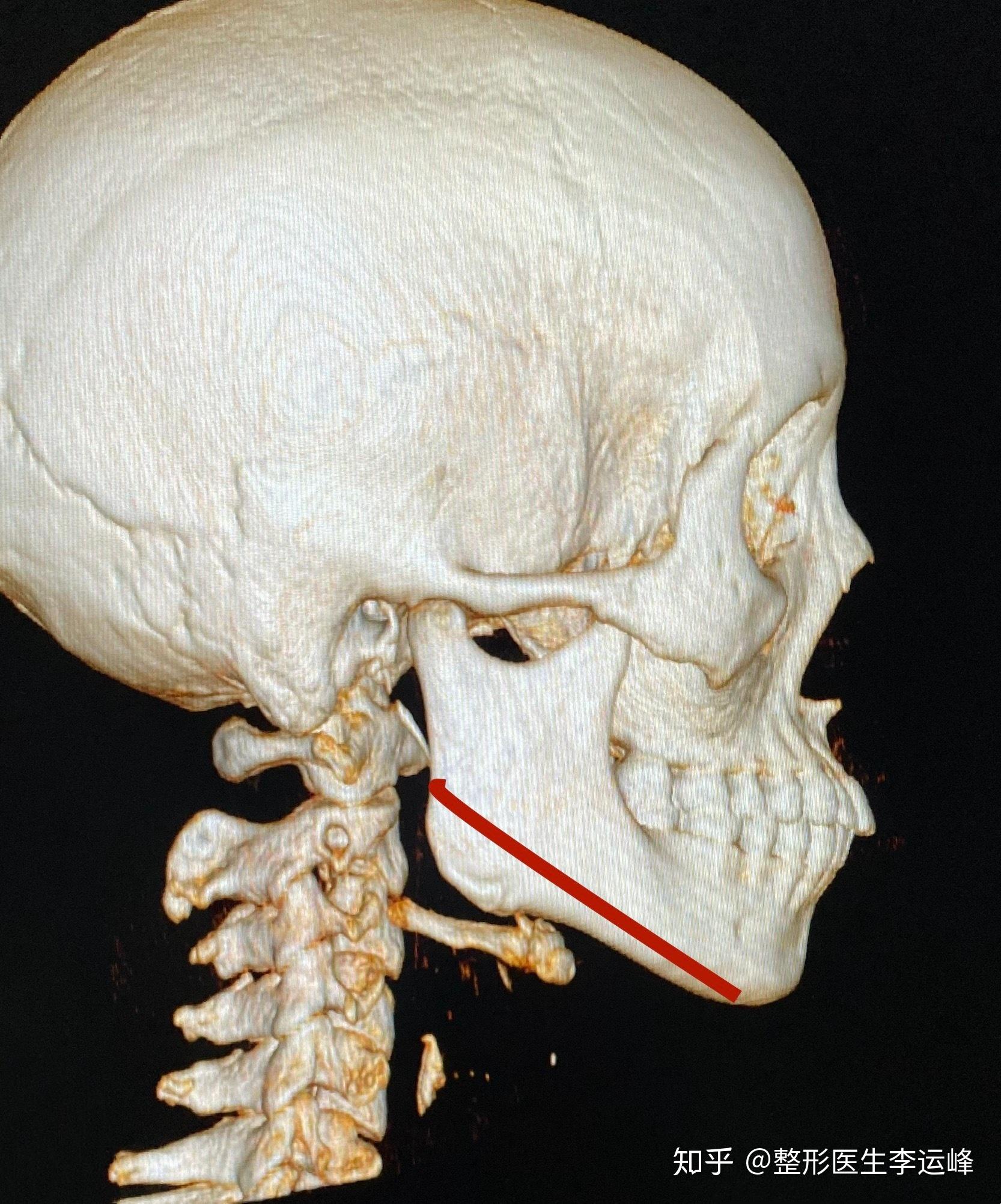 新鲜的术后ct,下颌角 颏成形,是针对短宽面型的有效手术方式.