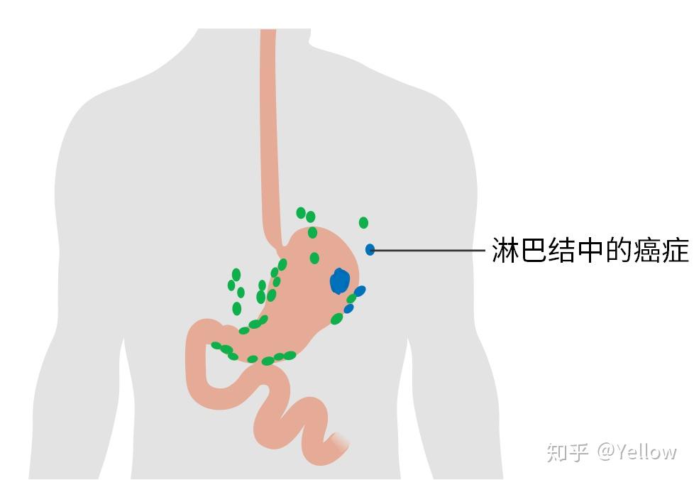 什么是淋巴结淋巴结和癌症有什么联系
