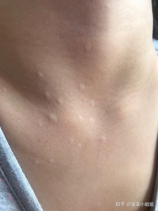 α姐姐说疤痕白色疤痕色素脱失