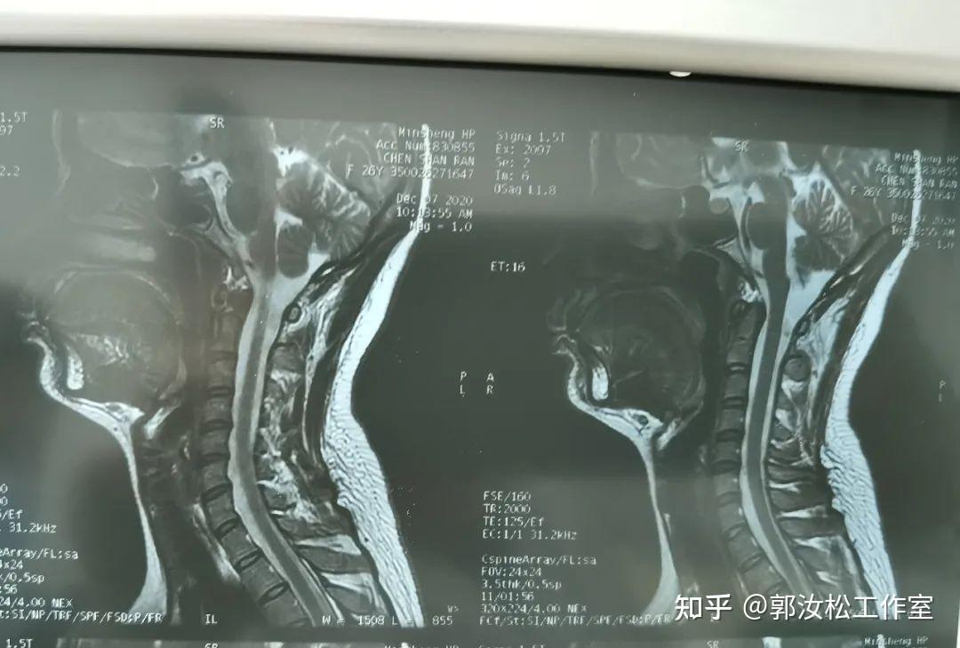 頸椎影像學檢查查體:頸肩部肌肉緊張,c2/3棘突旁壓痛,霍夫曼徵陰性