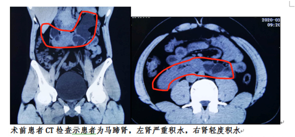 西安唐都医院完成单切口经脐三角腹腔镜 马蹄肾切除合并对侧肾复位固
