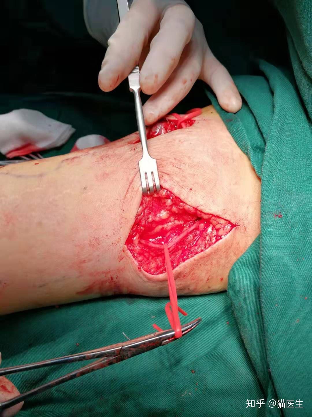 优化设计方案治疗头静脉弓狭窄闭塞