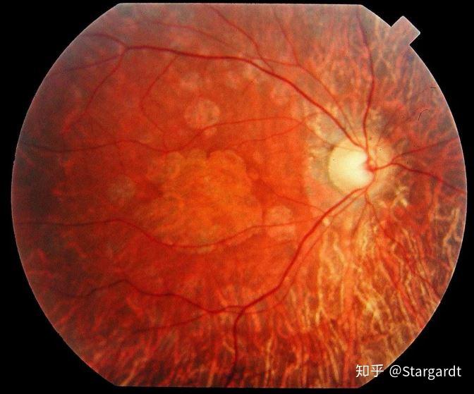 病理分析 | 锥杆细胞营养不良疾病综述