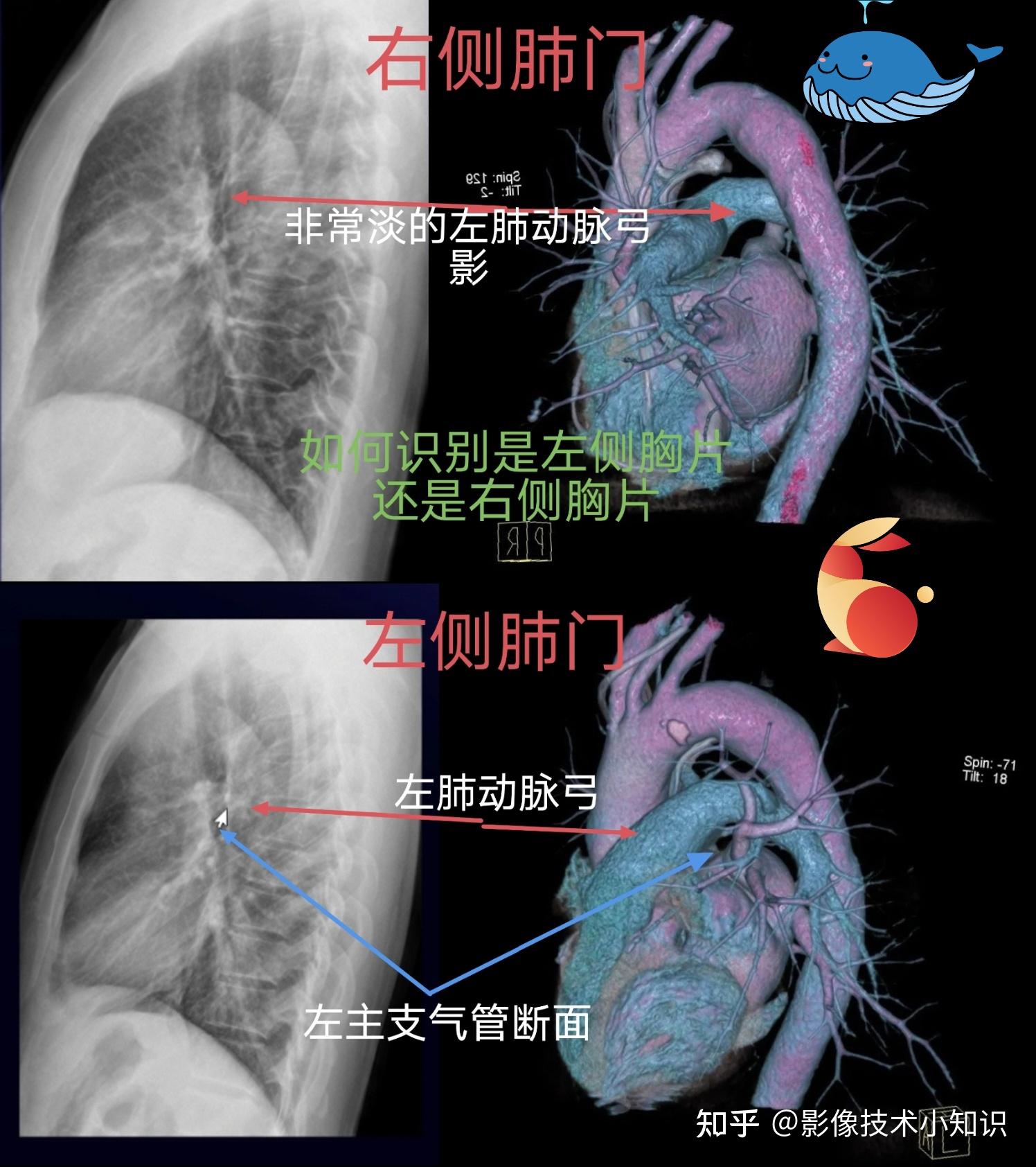 如何识别侧位胸片是左侧位还是右侧位 - 知乎