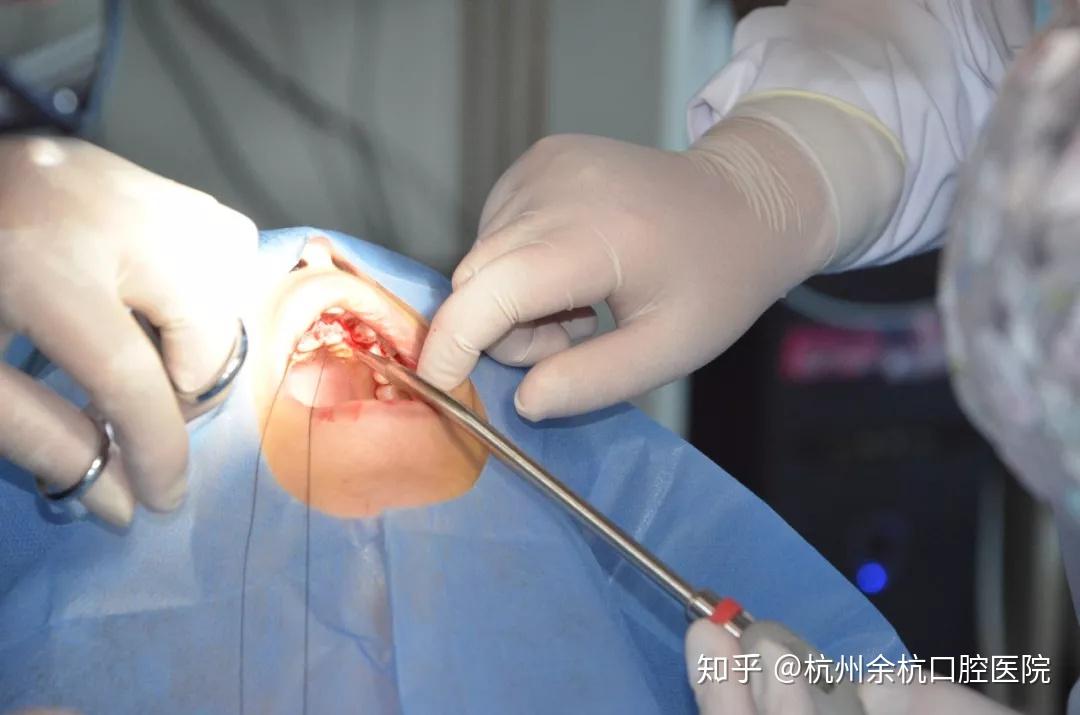 案例分享埋伏牙拔除