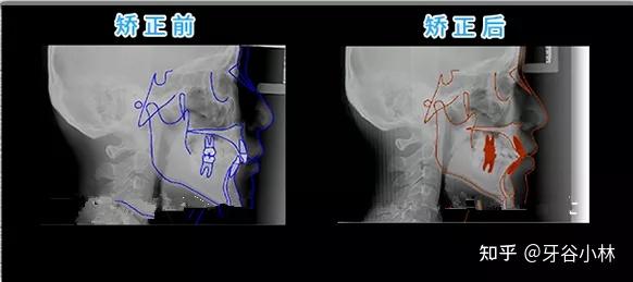 前牙三度深覆矫正 解除面部不协调，告别嘴突没下巴！ 知乎