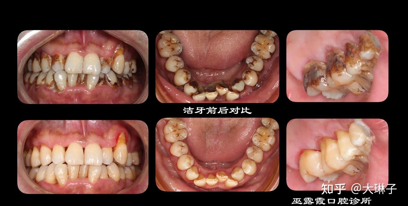 洗牙前后照片图片