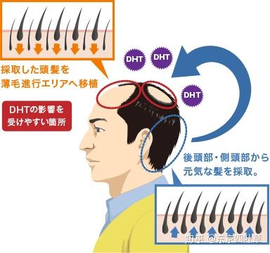 重返頭髮烏黑濃密時代-般若波羅蜜|日本整形