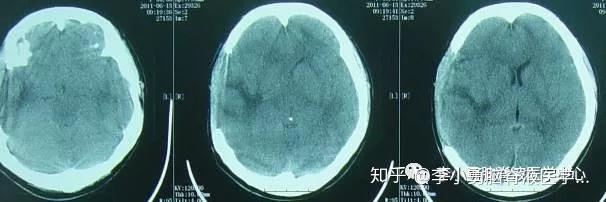 在腦ct檢查發現右側硬腦膜下出血和腦挫傷的表現之後(圖1),於當天進行